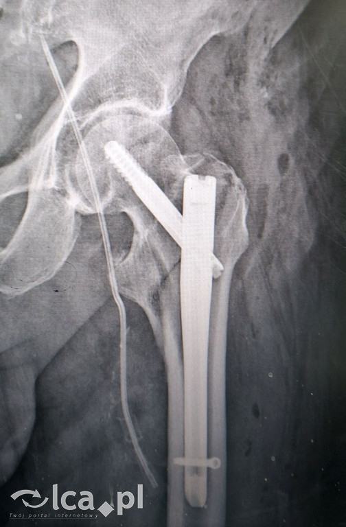 Pierwszy taki zabieg w szpitalu