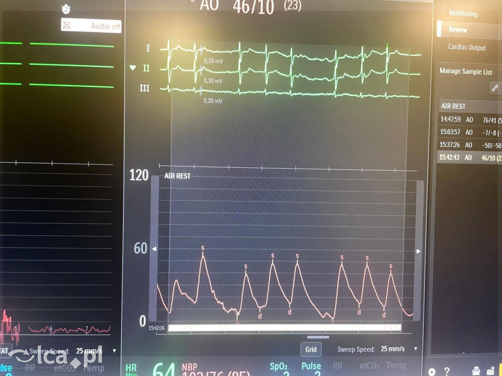 Pierwszy taki zabieg w szpitalu