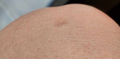 W niedzielę badania w kierunku czerniaka, decyduje kolejność zgłoszeń