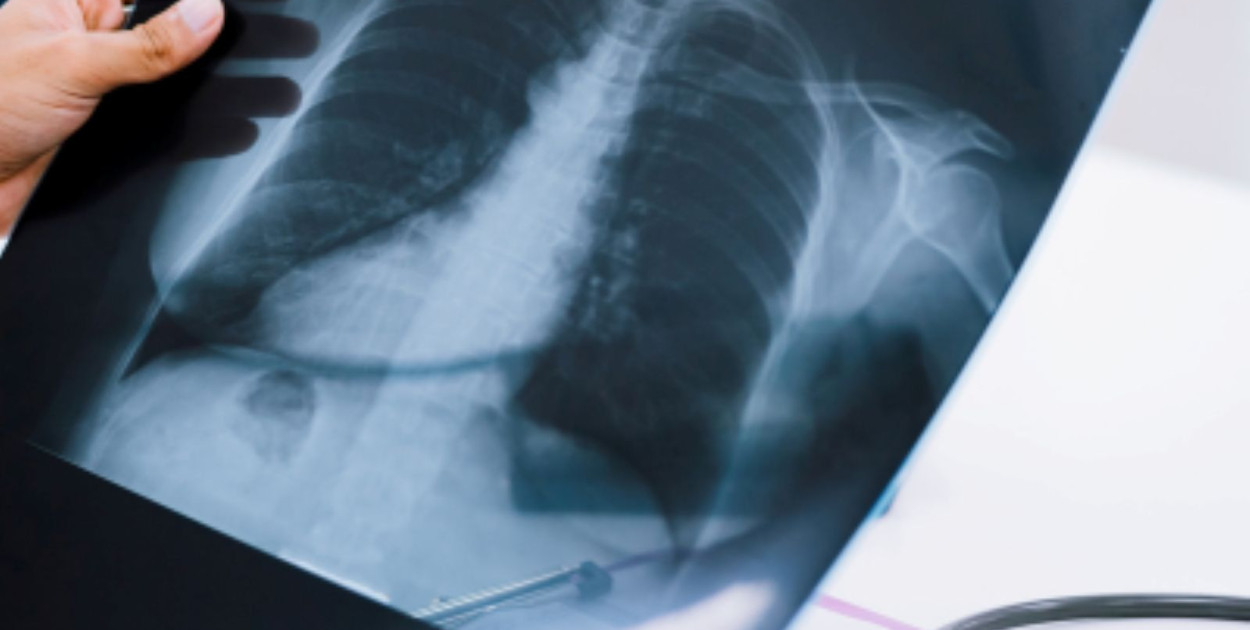 Płuca (źródło: Pixabay)